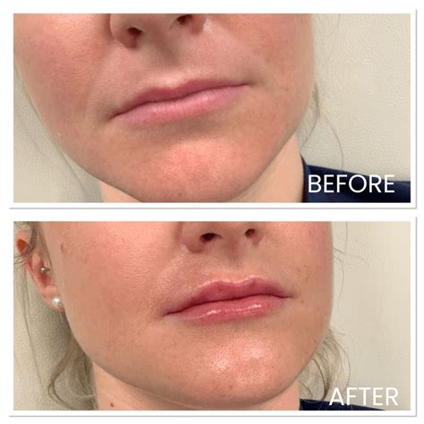 Lip Filler Before and After: MySkyn Clinic