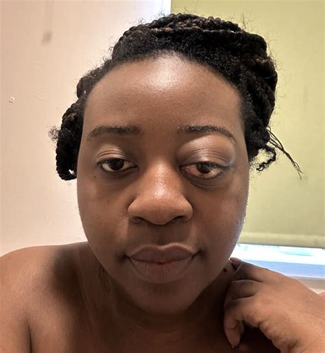 ‘Doctors told me it was a simple stye – then my eye was bulging out of its socket' | Need To Know