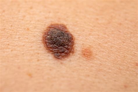 Age Spots vs. Melanoma: How to Tell the Difference