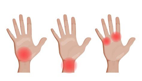 Depicting various types of hand pain. Wrist, finger, and joint discomfort. Medical and ...
