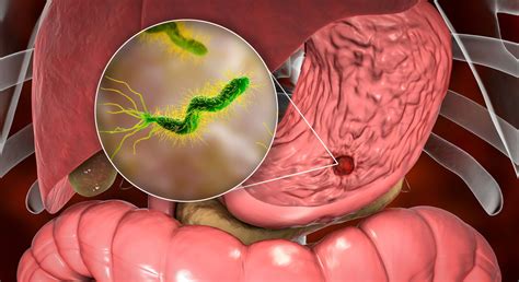 Qué es el helicobacter pylori, un factor de riesgo importante para el cáncer gástrico