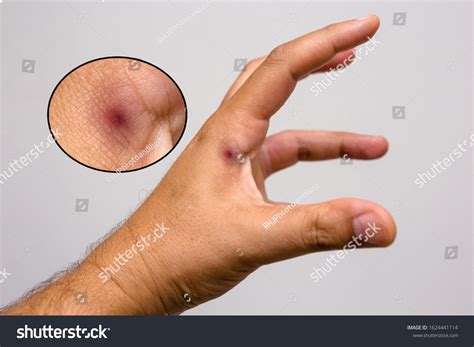 Scorpion Sting Wound