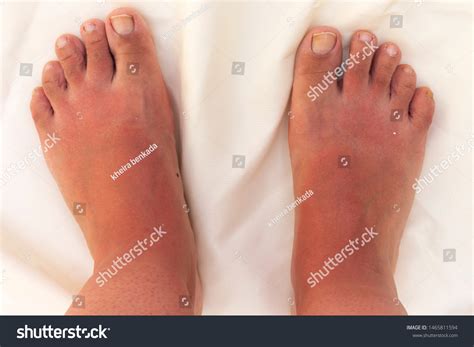 Rash From Indoor Tanning