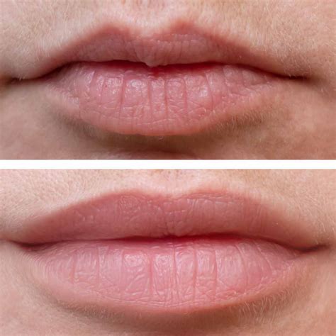 Lip Injection Chart at Rose Hutchinson blog