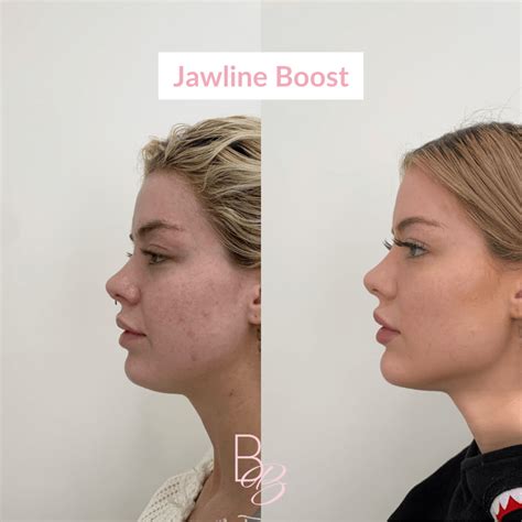 Strong Jawline Female – Female Jawline – JJPHOE