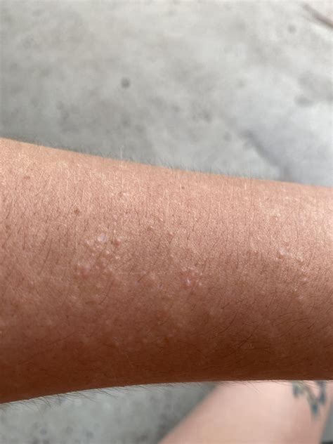 Red Bumps On Arm Not Itchy at Beverly Browning blog