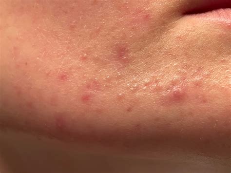 Tips on how to get rid of these spots and closed comedones : r/acne