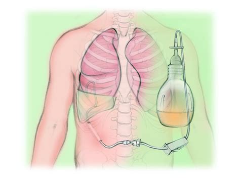 Draining A Pleurx Catheter Video at Jeff Updike blog