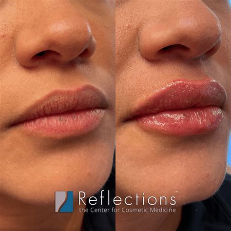 Lip Filler Before and After Photos and Results - the daily glimmer