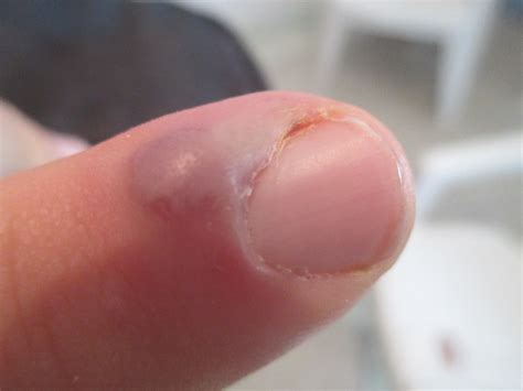 Ingrown Thumb Nail