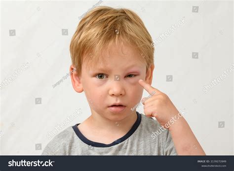 Стоковая фотография 2139272849: Portrait Boy Swollen Eye Insect Bite ...