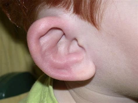 A Red Ear - The Journal of Pediatrics