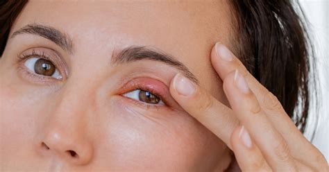 Can You Pop a Stye? | 1-800 Contacts