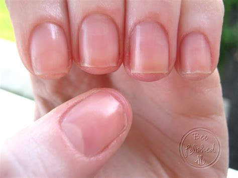 Nail Bed Nail Plate Separation at Evelyn Varney blog