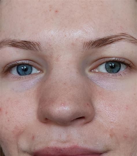 Wide and flat nose bridge but pointy nosetip, rhino plastic surgery ...