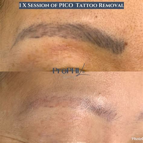 Laser treatments before & after photos