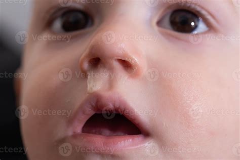 Yellow snot from a child s nose, close-up. Sinus infections, colds and ...
