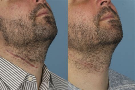 Scar Revision Surgery Chicago, IL |Dr. Sidle