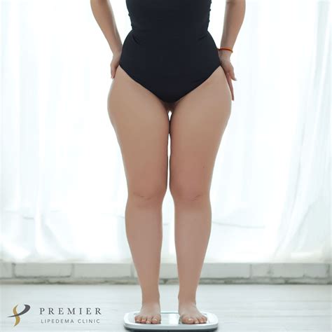 Lipedema is metabolically the opposite of obesity - both are associated ...