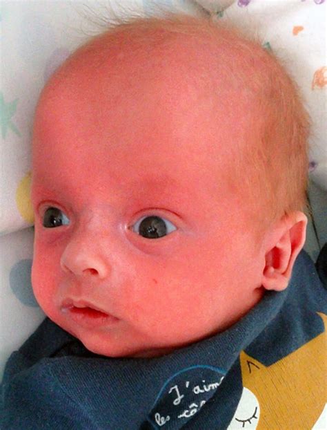 What Is The Medical Term For Red Man Syndrome at Jai Patrick blog