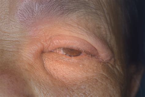 Herpes Zoster Ophthalmicus Hutchinson Sign