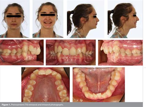 What Is Class 2 Division 1 Malocclusion at David Laramie blog