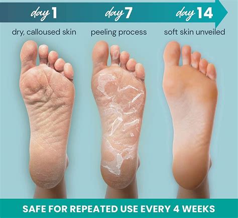 L'AMOUR Exfoliating Foot Peeling Masks - Removes Dead Skin & Calluses ...