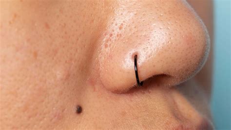 What Causes Black Moles to Suddenly Appear? – NutritionFact.in