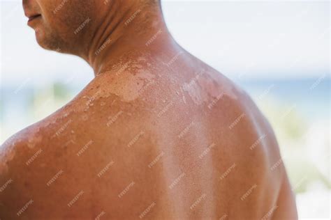 Premium Photo | Close-up of a man's shoulder with sunburn. the skin ...