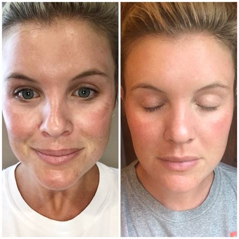 Vivace Rf Microneedling Before And After