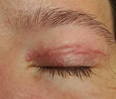 Keloid Scar Eyelid: Causes, Treatment & Prevention | Dr. Kopelman