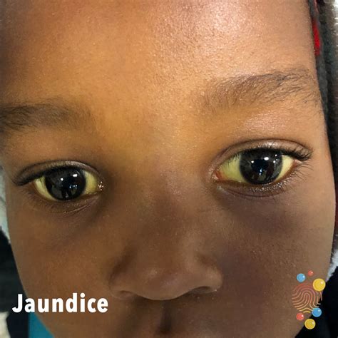 Baby Having Yellow Eyes at Kathleen Peltier blog