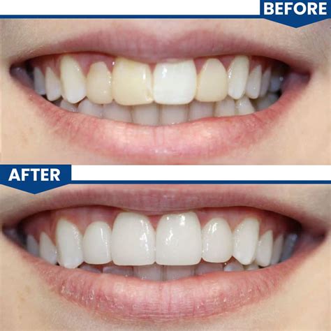 Healing Caps in Dental Implants | Central Valley Dentistry