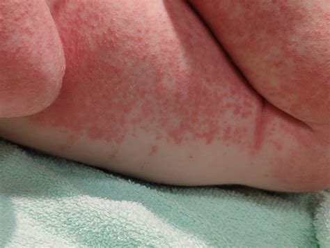 Benign Skin Changes of the Newborn – Pediatric Dermatology
