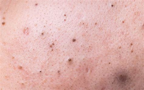Eliminate Back Blackheads: Your Guide to Clear Skin