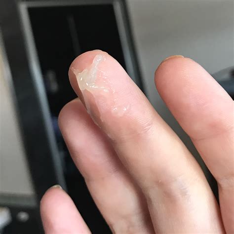 Clear Mucus Plug Discharge Spinnbarkeit Wikipedia