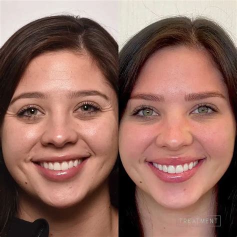 Lip Flip Before and After - Before After Journey