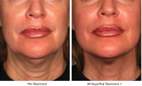 Face And Neck Lift Without Surgery