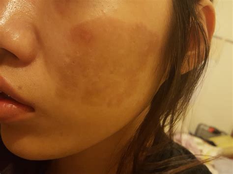 Burned Face Scar
