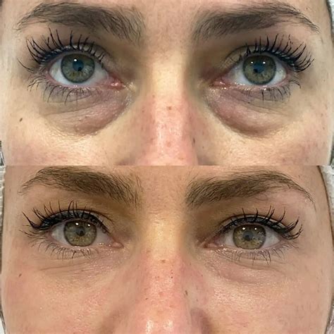 How Botox for Under Eye Bags Works and What to Expect