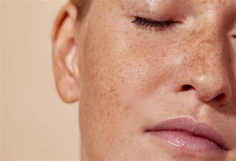 How Do You Remove Freckles? Safe Options for Clearer Skin