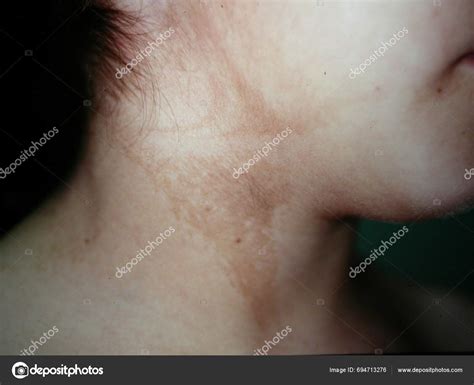 Woolly Hair Nevus Characterized Involvement Limited Scalp Curly ...