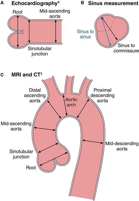 2022 ACC/AHA Guideline for the Diagnosis and Management of Aortic ...