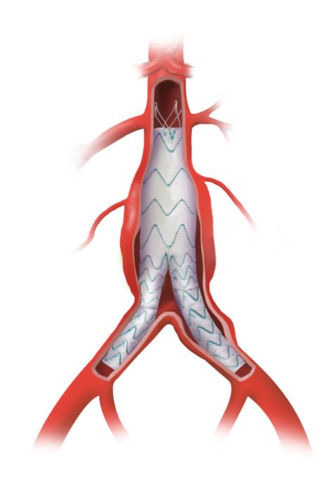 Major milestone for hospitals using Terumo Aortic’s Thoraflex™ Hybrid ...