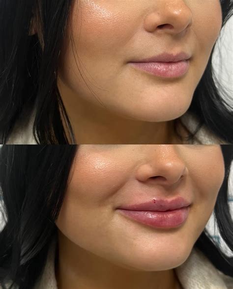 Lip injection before after gallery – Artofit
