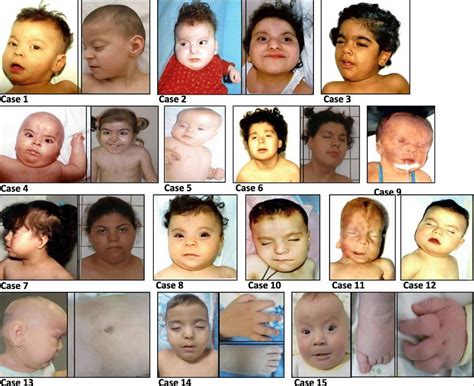 Pallister Killian syndrome, causes, symptoms, diagnosis, treatment ...