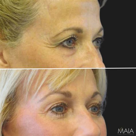 Brow Lift | Maia Plastic Surgery