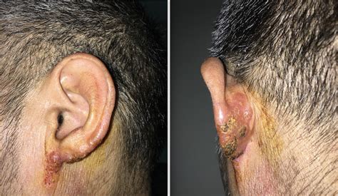 Swollen Lymph Node Behind Ear Lobe