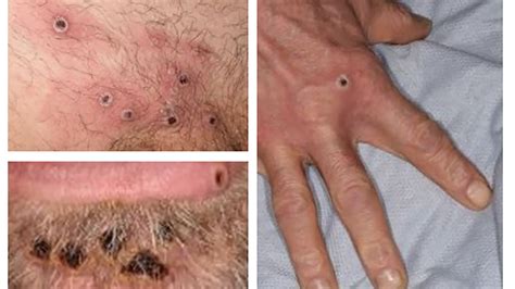 Monkeypox in Florida: Is your rash monkeypox, shingles or chickenpox?