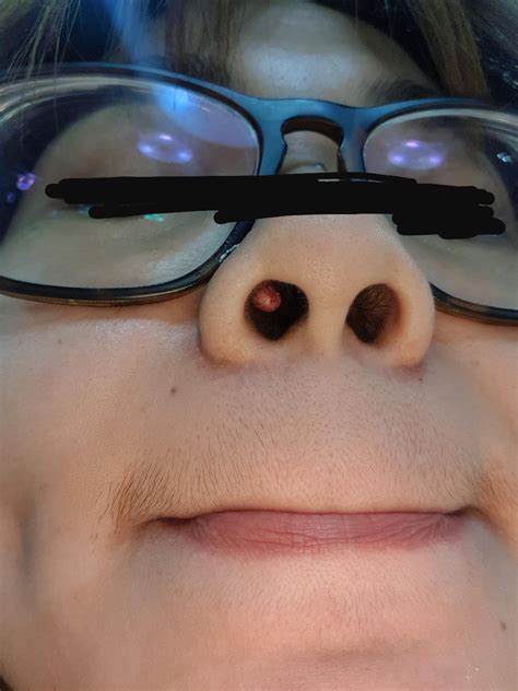 Piercing bump inside, help!! : piercing